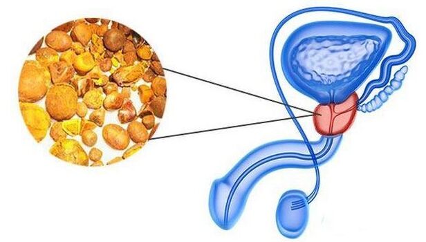 Calcine in the prostate gland