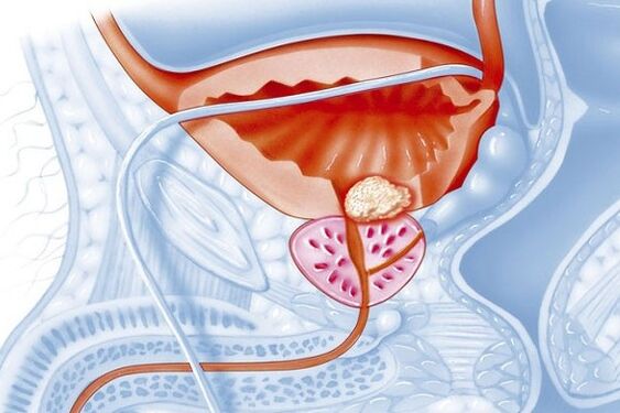 Inflammatory process in the prostate