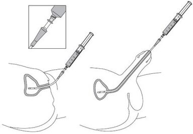Instillation of a drug solution to the urethra