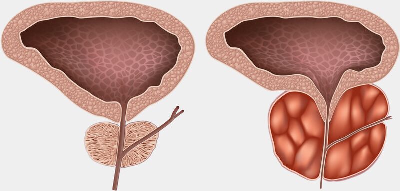 healthy, inflamed prostate with prostatitis