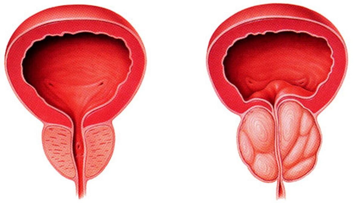 healthy, inflamed prostate with prostatitis