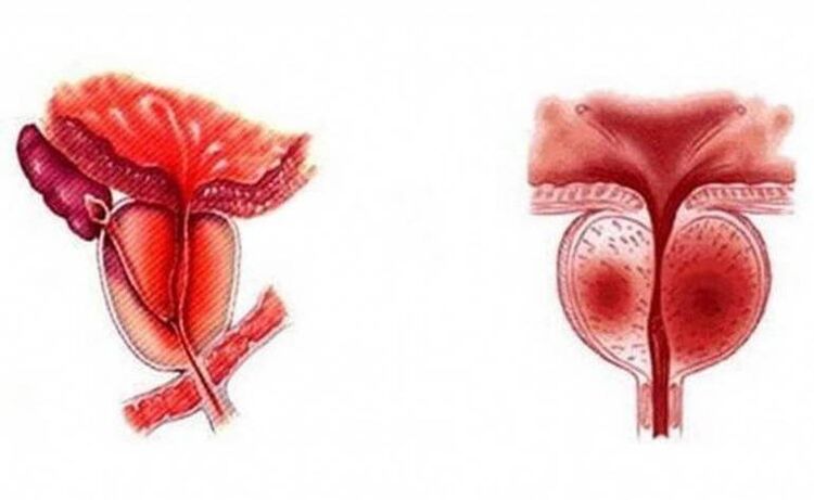 Acute inflammation of the prostate, which can become chronic