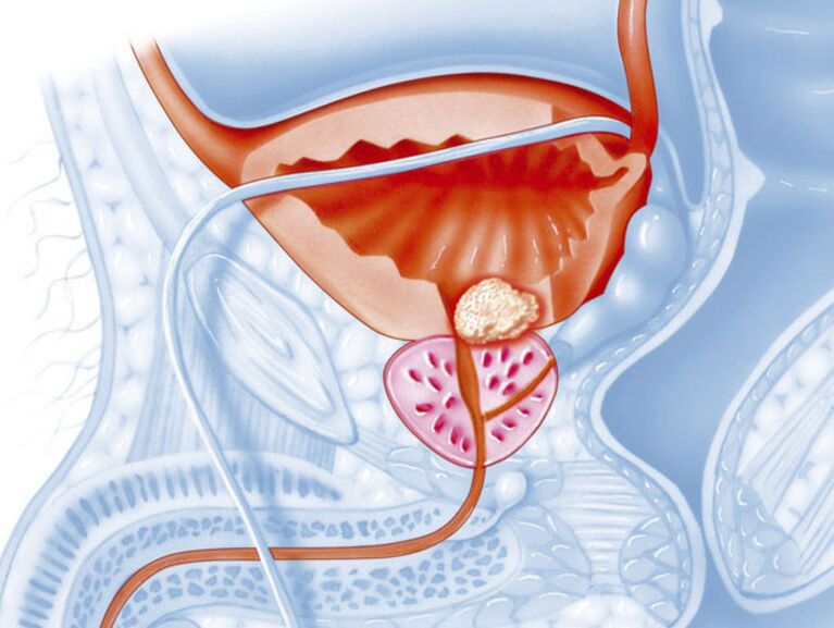 In chronic prostatitis, the lumen of the urethra narrows, making it difficult to pass urine. 