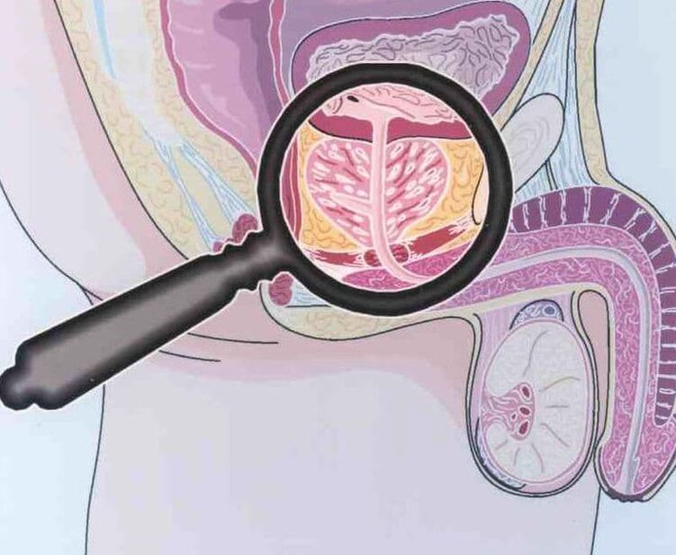 Loss of prostate tissue in patients with chronic male prostatitis